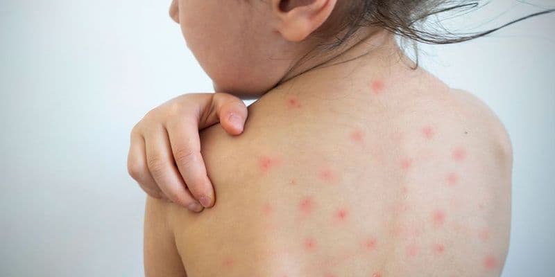 Brotes de sarampión se expanden en escuelas con baja vacunación